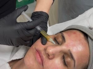 PRP skin treatment to the face by a Registered Nurse at MISUMI NutrAesthetics, Leeds